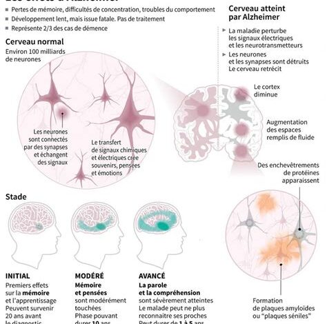 Un danger caché dans l’Alzheimer : les muscles s&rsquo;affaiblissent avant même la mémoire